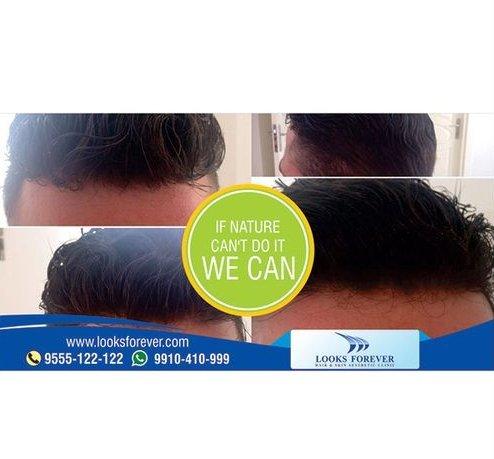 Menâs Hair Replacement 