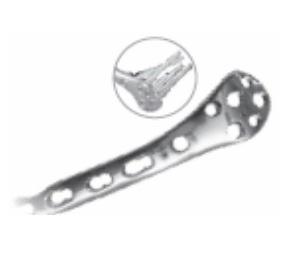 AS. Lateral Distal Femur Plate