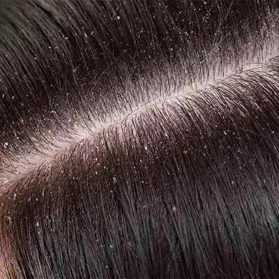 Gudbye Dandruff Oil
