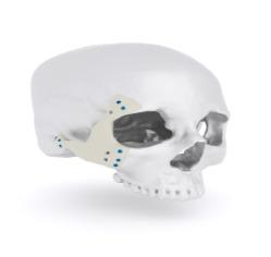Zygomatic & orbital floor implants