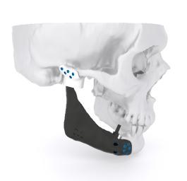 Mandible reconstruction implants