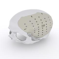 Cranial implants