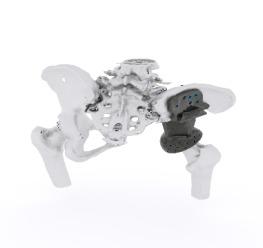 Orthopedics implants