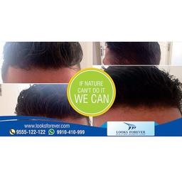 Menâs Hair Replacement