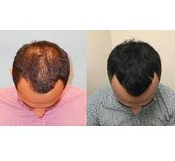 PRP Hair Growth
